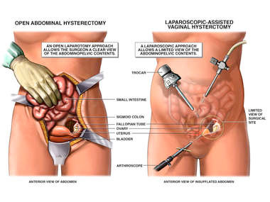 Laparoskopik Histerektomi (Kapalı Yöntem Rahim Alma Ameliyatı)