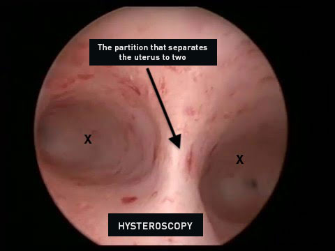HYSTEROSCOPY