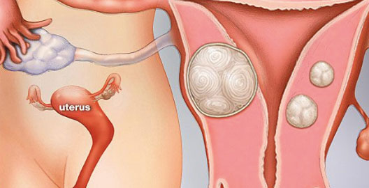 Myom Nedir?