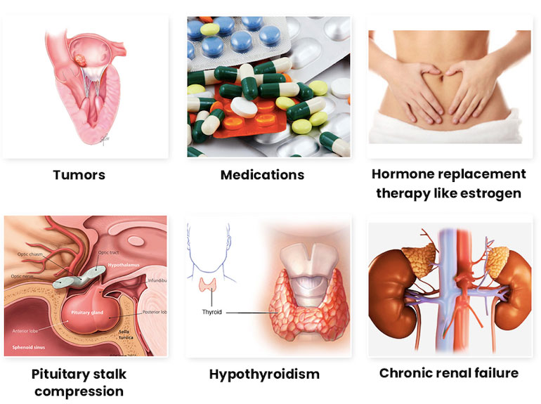 Hiperprolaktinemi [Prolaktin (Süt Hormonu) Hormonunun Fazla Salgılanması]