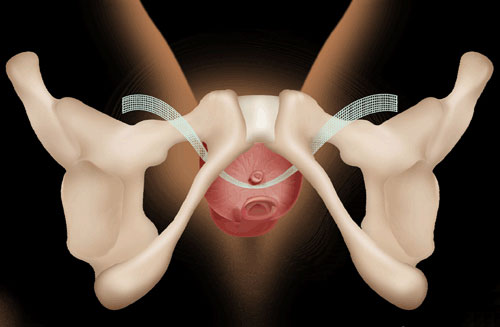 "Transobturator Tape (TOT) / Transvaginal Tape (TVT)" ameliyatı olan her 10 kadından 8’inde belirgin iyileşme görülür.